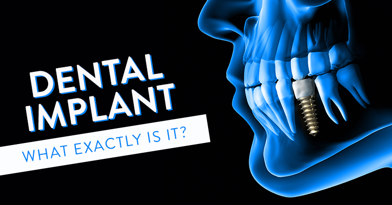 what exactly is a dental implant?