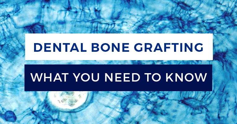 dental bone graft what you need to know